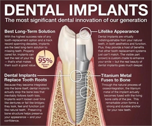 Dental Implant Infographic