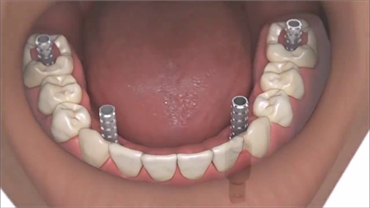 Dental Implants in South Delhi - SouthEx Dental