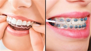 traditional braces and Invisalign Braces