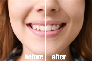 gum contouring treatment before and after result