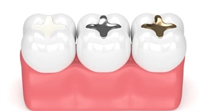 dental fillings types