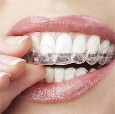 Invisalign straigher teeth at Orlando FL dentist East Orlando Dental