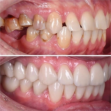 Permanent tooth implant