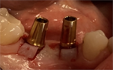 Dental implants installed by Dr. Webster at Kelowna Dental Centre