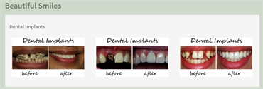 Before and After Images - Agave Dental Care