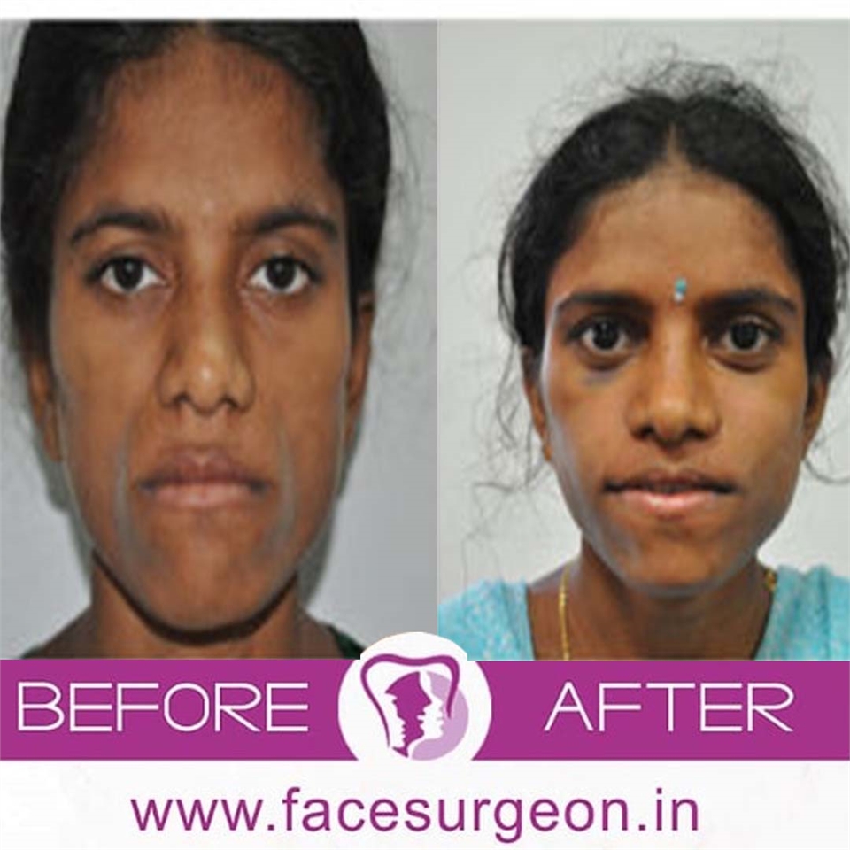 Cosmetic Procedures Cosmetic Rhinoplasty Treatment In India