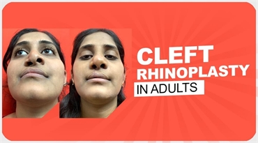 Rhinoplasty for Cleft Nasal Deformity 