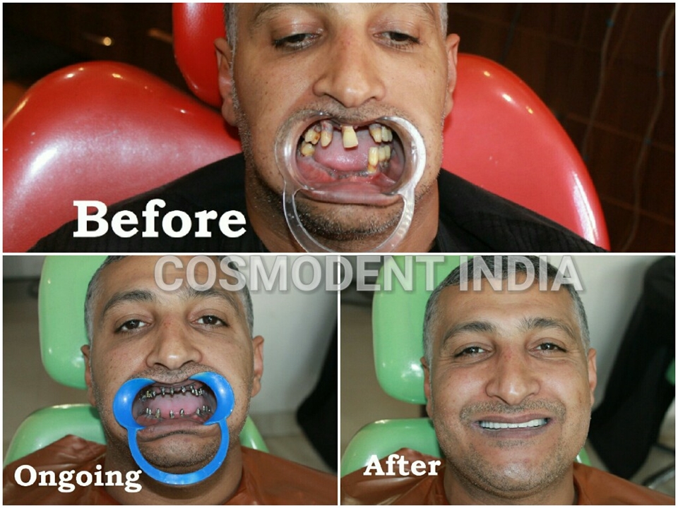 Dental Implants Before And After