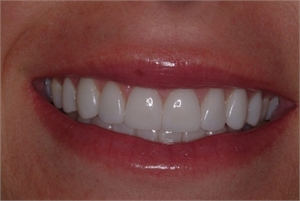 Dental veneers are suitable for patients who want permanently whiter teeth. 