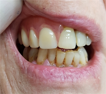 Flexible Nylon Partial Dentures AFTER