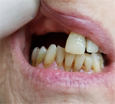 Flexible Nylon Partial Dentures before