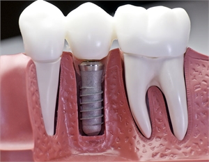 Why A Dental Implant May Be The Best Way To Preserve Your Smile