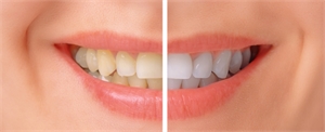 Teeth Whitening Options for Sensitive Teeth