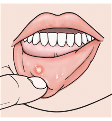Causes and Treatment for Canker Sores in Children