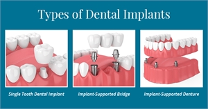 Dental Implants Types