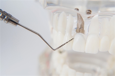 Dental Implant Surgery Process