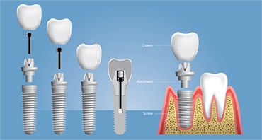 Everything you need to know about Dental Implants