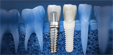 Maintaining Oral Hygiene After Getting Dental Implants Tips and Tricks