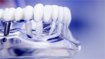 Smile Restoration 101 Exploring Dental Implants as a Solution
