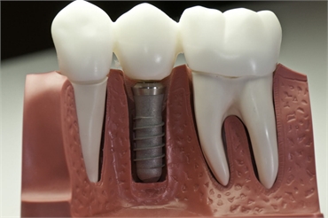 7 Reasons Why Dental Implants Are The Gold Standard