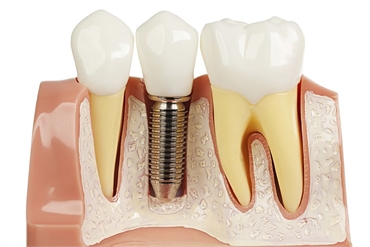 Dental Implants Omaha NE