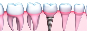 Dental Implants Everything you need to know about the procedure