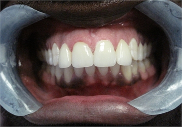 Healthy White After Retracted 703 753 8600 Dentist Gainesville VA