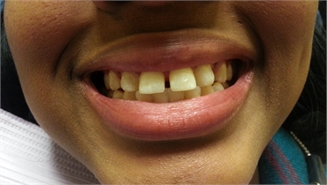 Uncleaned Teeth Before Smiling 703 753 8600 Dentist Gainesville VA