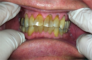Unhealthy Uncleaned Before Retracted 703 753 8600  Dentist Gainesville VA