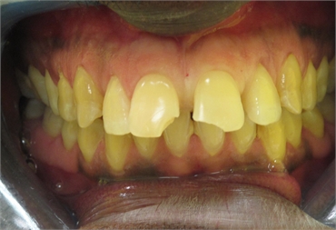 Broken Tooth Before Retracted 703 753 8600 Dentist Gainesville VA