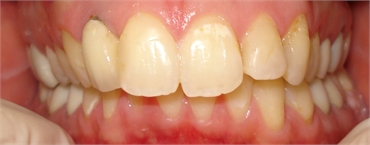 Dirty Teeth Before Retracted 703 753 8600 Dentist Gainesville VA
