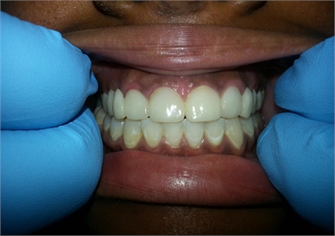 Clean White Teeth After Retracted 703 753 8600 Dentist Gainesville VA