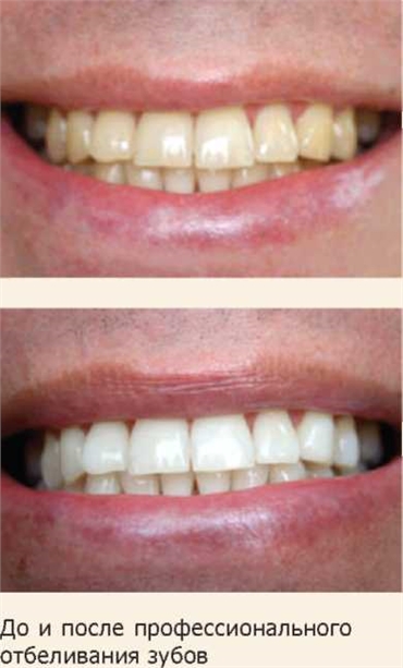 teeth Whitening