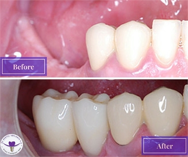 Treatment for Missing Teeth