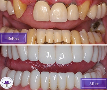 Full Mouth Reconstruction by Dental Implants