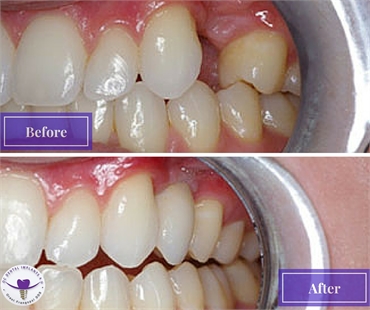 Single tooth implant at OC Dental Implants